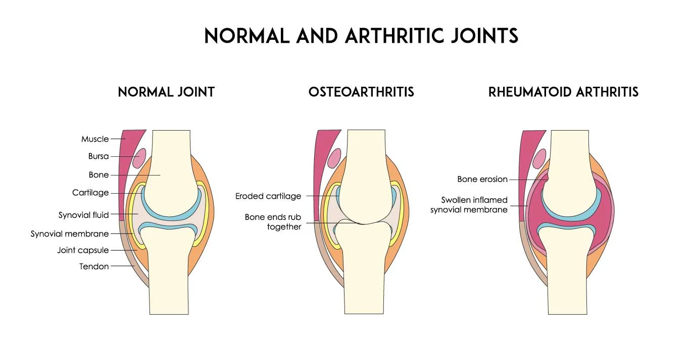 causes-arthritis