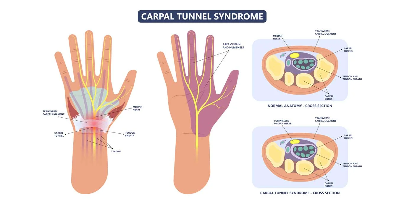 tunnel-syndrome